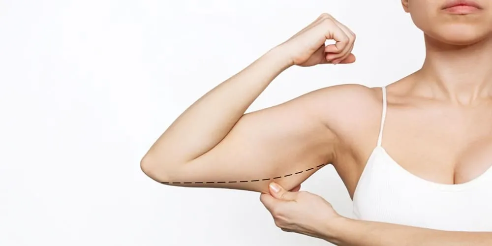 Arm Liposuction in Cyprus