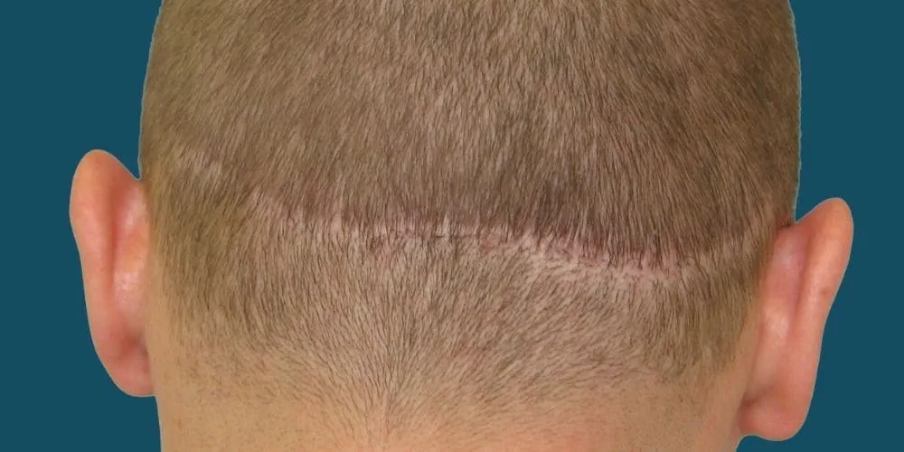 FUT Hair Transplant Cyprus
