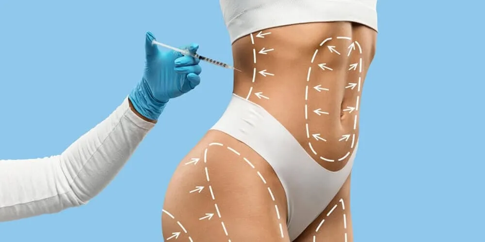 Kıbrıs'ta Liposuction Tedavisi
